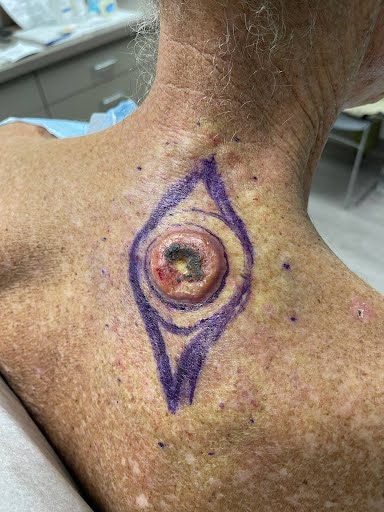Day of surgery-doc's markings